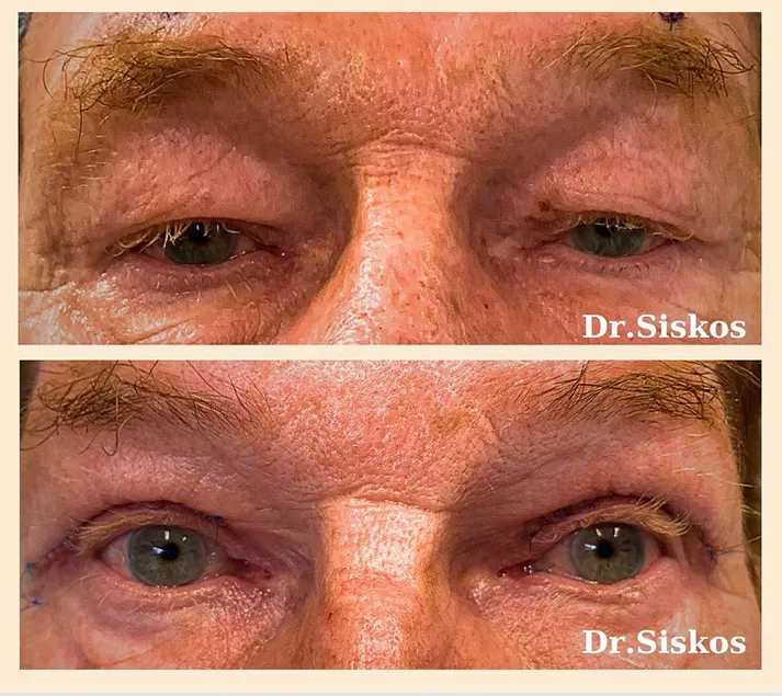 pitsavou-eleni-siskos-giorgos-ofthalmiatros-blefaroplastiki-ano-blefaron-featured