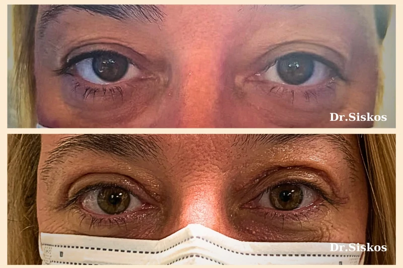 pitsavou-eleni-siskos-giorgos-ofthalmiatros-blefaroplastiki-ano-blefaron-anaisthisia