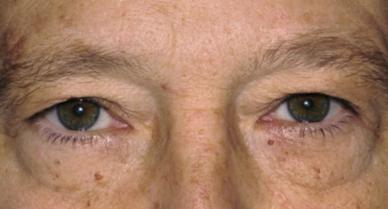 pitsavou-eleni-siskos-giorgos-ofthalmiatros-blefaroplastiki-ano-blefaron-dermatoxalasi