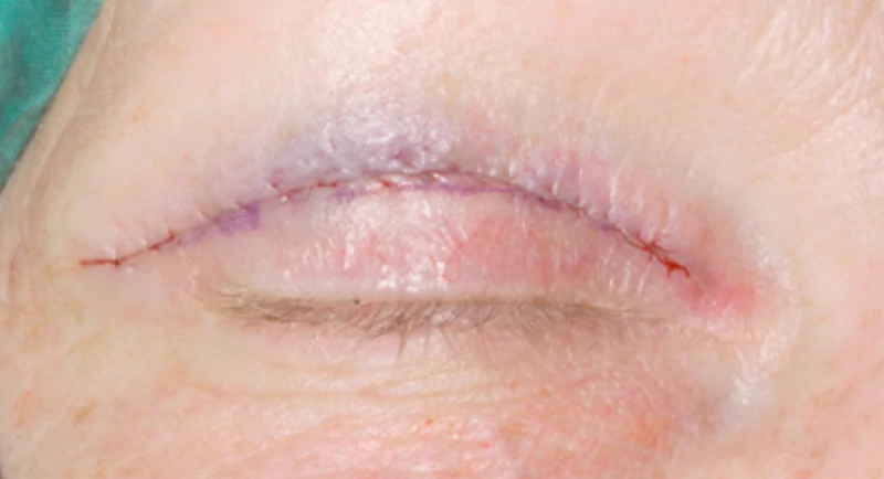 pitsavou-eleni-siskos-giorgos-ofthalmiatros-blefaroplastiki-ano-blefaron-ramma