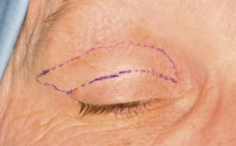 pitsavou-eleni-siskos-giorgos-ofthalmiatros-blefaroplastiki-ano-blefarwn-rammata